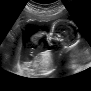 quando é possível ver o bebê no ultrassom
